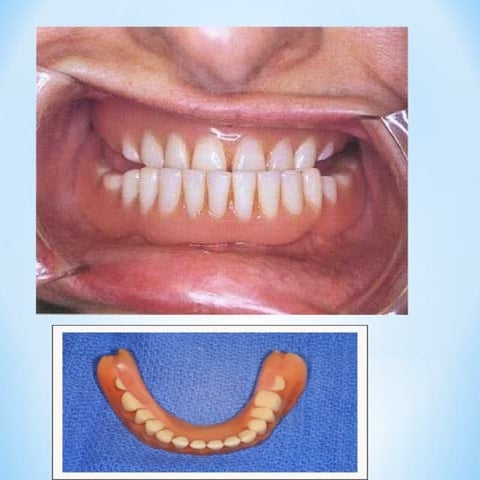 20. Copy dentures +RELING RhhhhEBASING.ppt