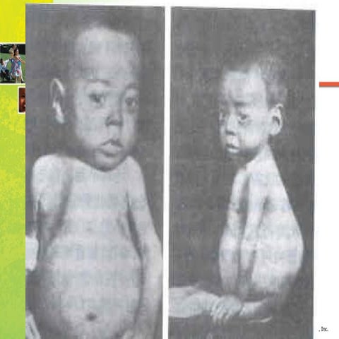 Rickets Rehabilitation program | PDF