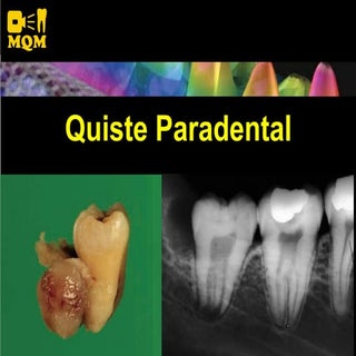 2009 Quiste Paradental