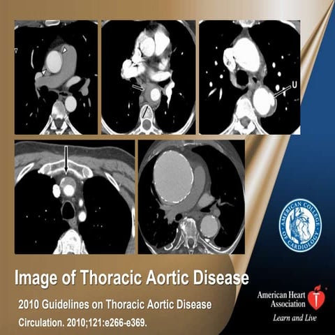 Traumatic Aortic Disruption - Deceleration injury | PPT