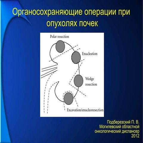 Резекции почек по поводу опухолей