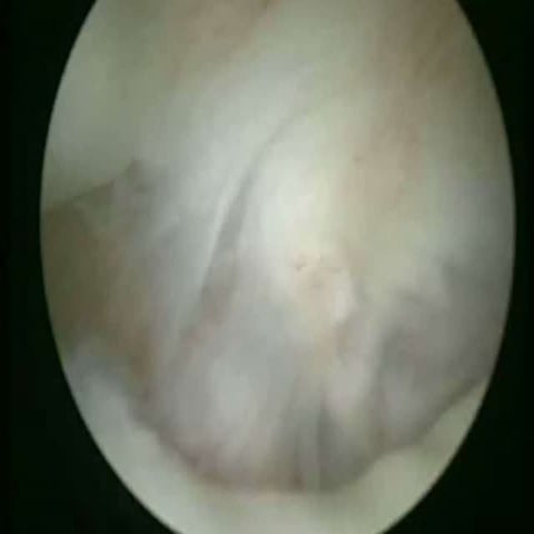 Αρθροσκόπηση του Καρπού, απο την Κλινική Εξέταση στις Σύνθετες Επεμβάσεις- Wr...