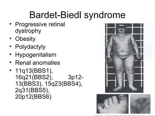 Laurence Moon Bardet Biedl Syndrome- Case Report And Review Of Liter…