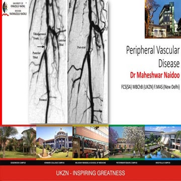 Jet Stream Pathway Device in Peripheral Arterial Disease. | PDF
