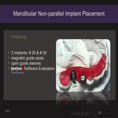 20 mandibular non parallel implant placement