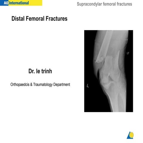 distal femur fracture