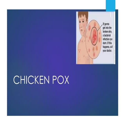 22.CHICKEN POX.pdf