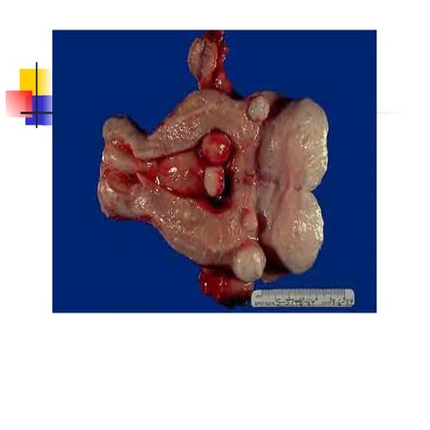 22.Leiomyoma Of The Uterus