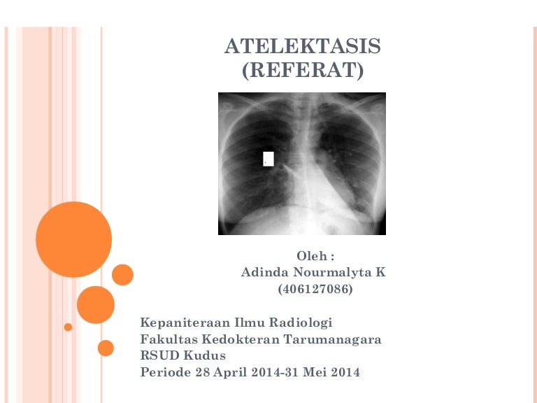 232593414 atelektasis-radiologi-ppt