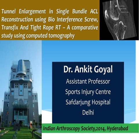 Tunnel Enlargement in Single Bundle ACL Reconstruction Using Bio-Interference...