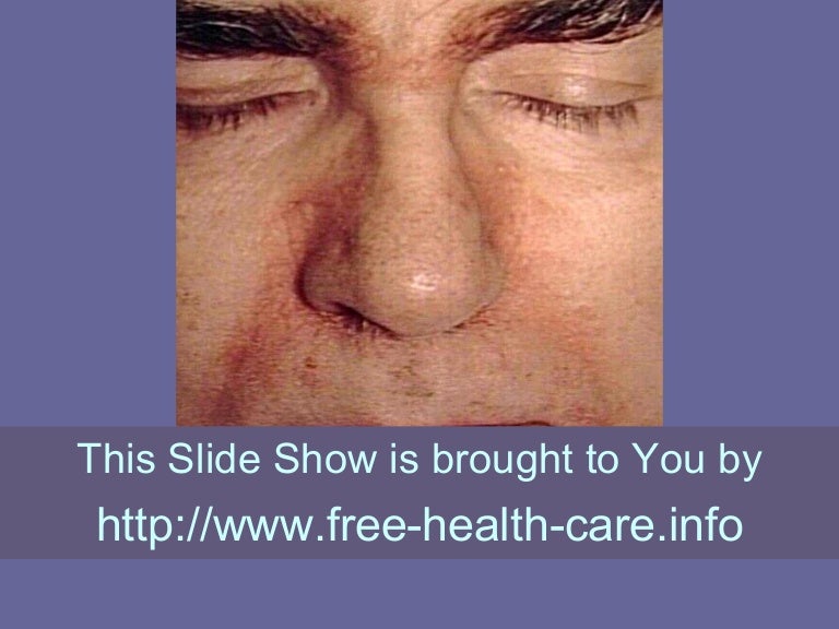 The Essential Home Remedies For Seborrheic Dermatitis