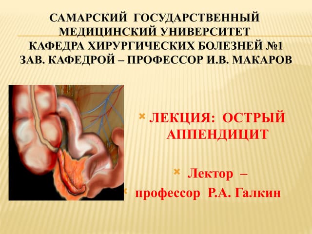 Acute appendicitis all information about