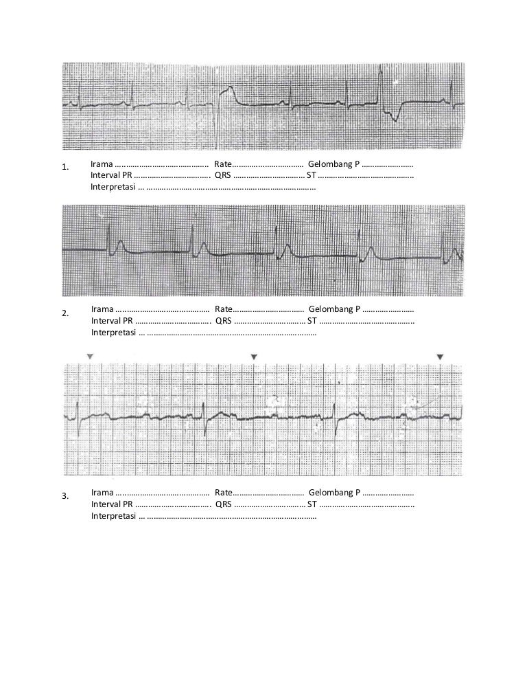 106+ Contoh Soal Interpretasi Ekg Dan Jawabannya + Jawaban 106+ Contoh Soal Interpretasi Ekg Dan Jawabannya + Jawaban
