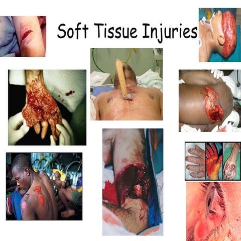 25)Soft Tissue Injuries