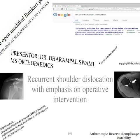 RECURRENT SHOULDER DISLOCATION. DR. DHARAMPAL SWAMI