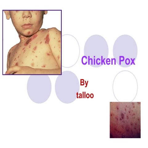     chicken pox