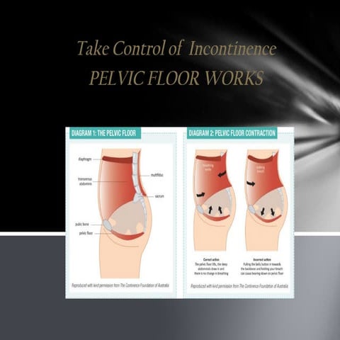 PT MANAGEMENT OF URINARY INCONTINENCE.pptx