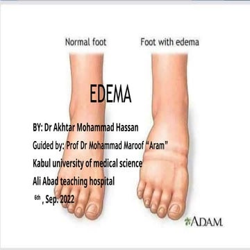 29 EDEMA Dr Akhtar Mohammad diagnosis.pptx