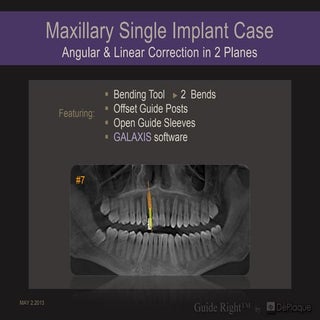 2 basic fabrication  maxillary sing...
