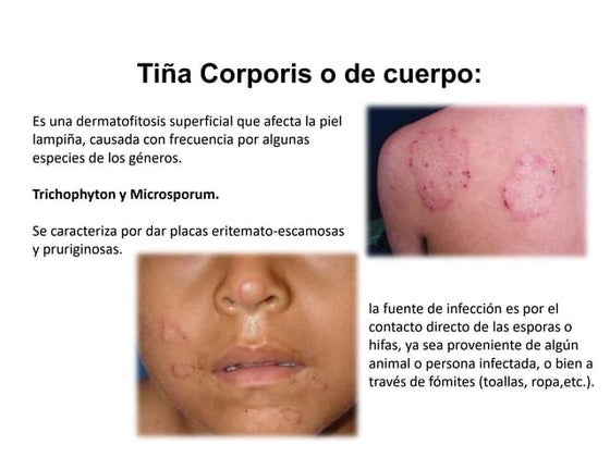 Tiña de la ingle o Tinea cruris.pptx | Skin and Dermatology | Diseases ...