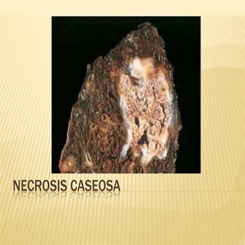 2 necrosis caseosa 