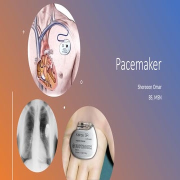 2 pacemaker how to put a pacemaker and how it works and some of its ...