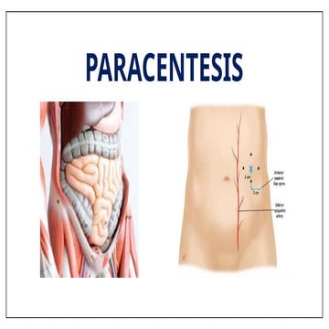 2_Paracentesis[1].pptxcccccccccccccccccc | PPTX