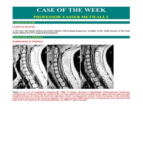 Case record...Congenital syringomyelia