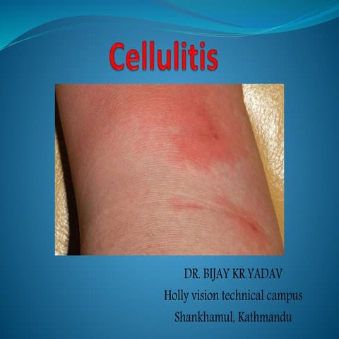 3. Cellulitis