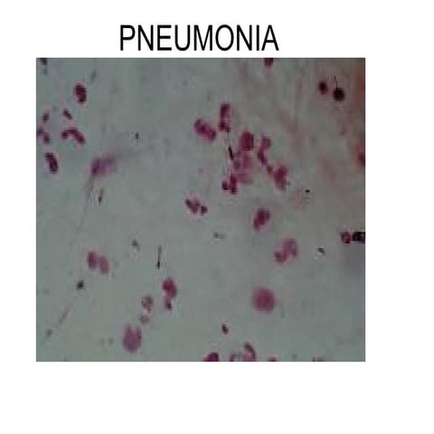 pneumonia in adults. causes, epidemiology, clinical presentation and ...
