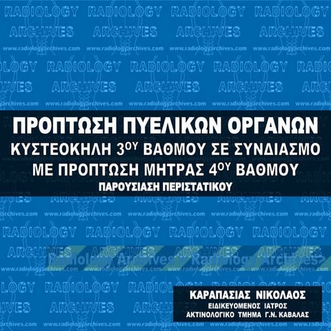 Κυστεοκήλη 3ου Βαθμού σε Συνδιασμό με  Πρόπτωση Μήτρας 4ου Βαθμού