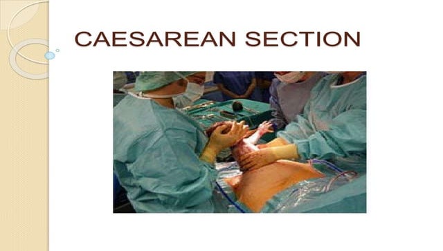 Cesarean Section Procedure Step By Step