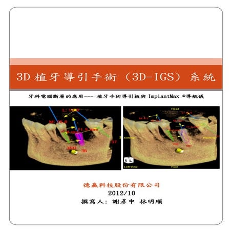 3D植牙導引手術系統