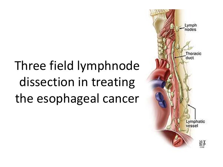 3 field lymphnode dissection of esophagus