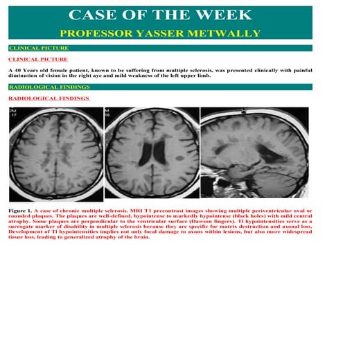 Case record... Multiple sclerosis | PDF