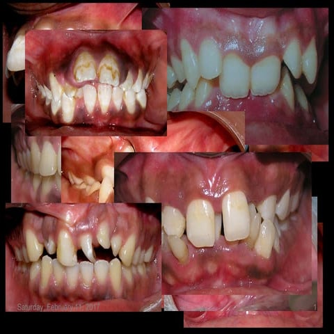 classification of malocclusion