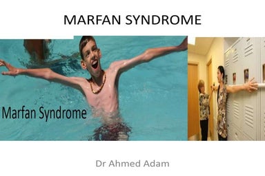 Marfan Syndrome Phelps