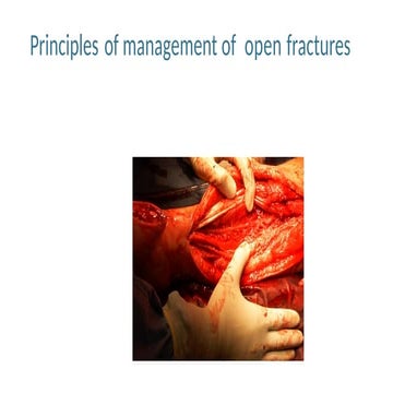 4.Open Fracture management 2..-1 (1).pptx