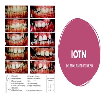 Index of Orthodontic Treatment Need (IOTN) | PPT