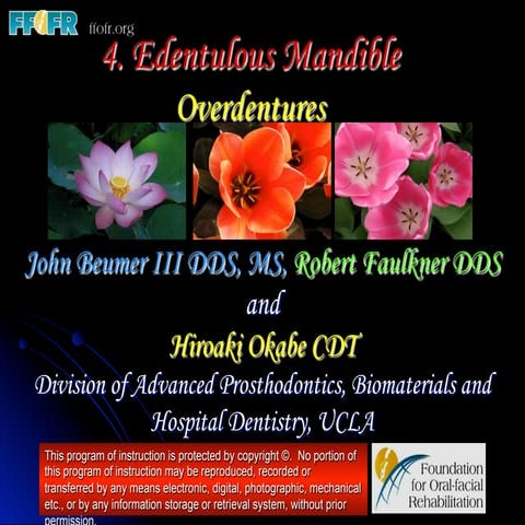 Edentulous Mandible - Overlay Oentures