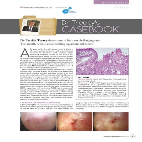 Dr. Treacy's Casebook: Treating Squamous Cell Cancer | PDF