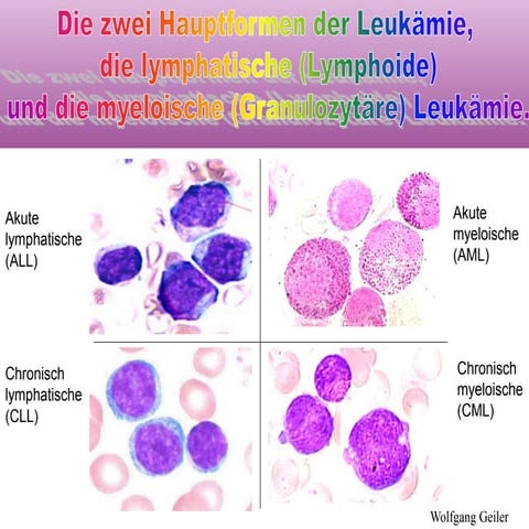 Welche Arten Von Leukämie Gibt Es