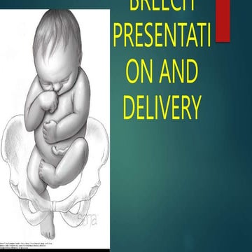 Breech presentation and child delivery pptx | PPTX