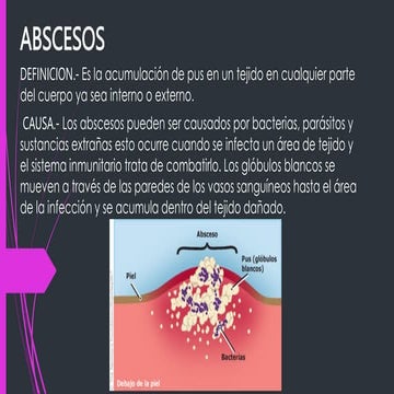 absceso completo PATOLOGIA Y TIPOS DE ABSCESOS.ppt