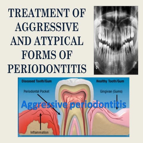 46.TREATMENT OF AGGRESSIVE AND ATYPICAL FORMS OF PERIODONTITIS.pptx