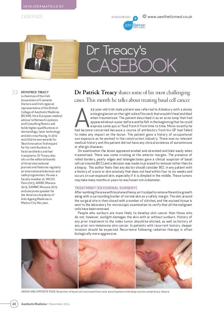 Treating Basal Cell Carcinoma