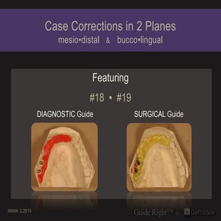 4 case corrections in 2 planes+ dem...