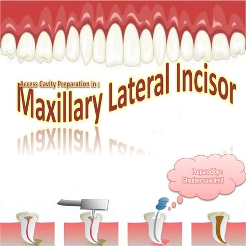 Access Cavity Preparation in :  Maxillary Lateral Incisor