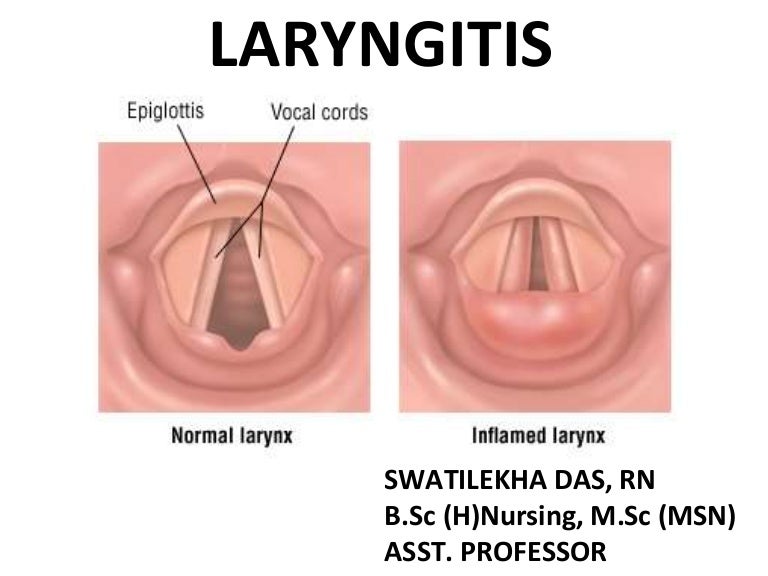 LaryngitisEasy PPT for Nursing Students
