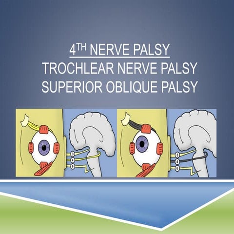 4th nerve palsy